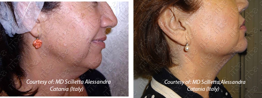microiniezioni per cellulite