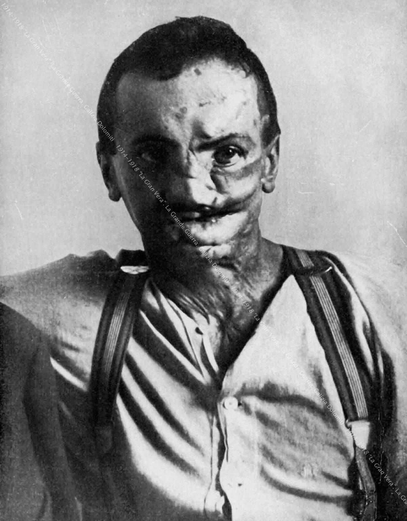 Ein fünfundzwanzigjähriger Landwirt, verwundet 1916 durch Granatsplitter.